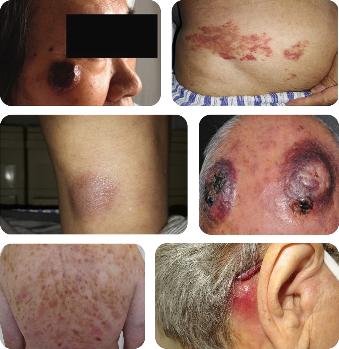 Examples of BPDCN skin involvement