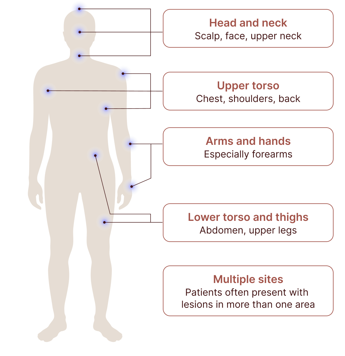 Head and neck: scalp, face, upper neck;Upper torso: chest, shoulders, back;Arms and hands: especially forearms;Lower torso and thighs: abdomen, upper legs; Multiple sights: patients often present with lesions in more than one area